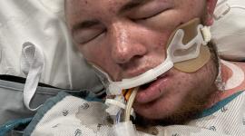 الشاب تعرض لغيبوبة بسبب لسعات النحل