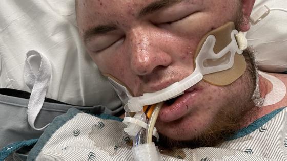 الشاب تعرض لغيبوبة بسبب لسعات النحل